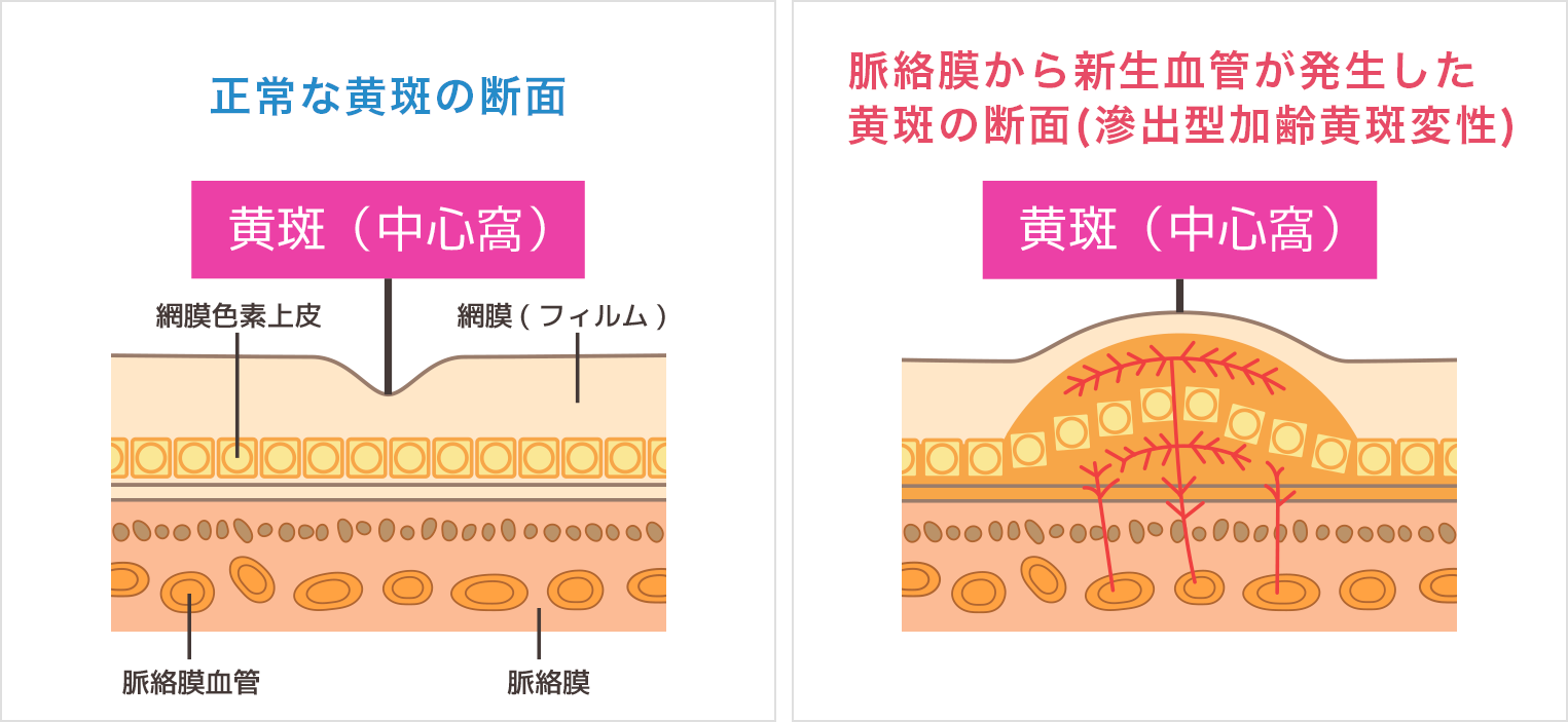 加齢黄斑変性症のメカニズム